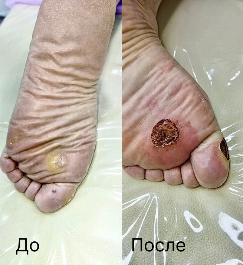 Лазерное удаление мазолей