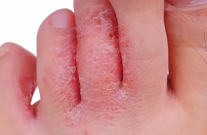 Экзема 😊 – причины, симптомы и современные методы лечения