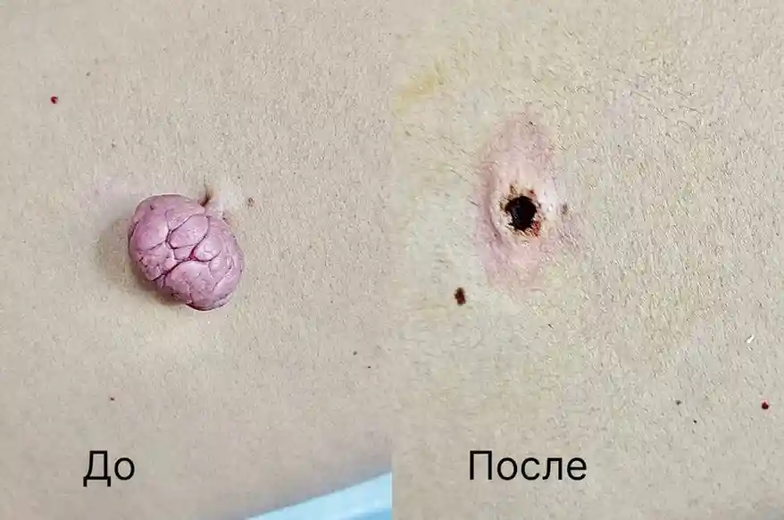 Лазерное удаление новообразований кожи